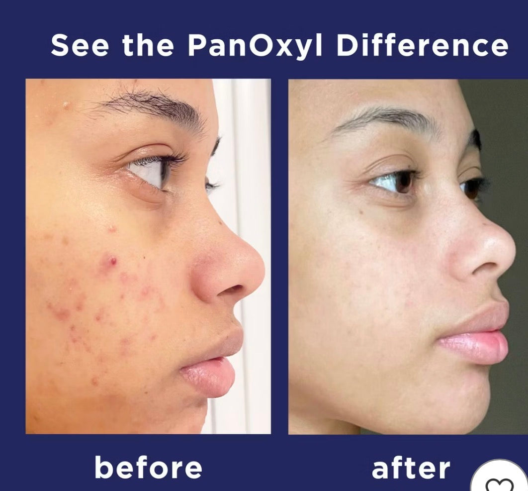 Traitement acné au benzoyle de peroxyde au Sénégal -- PanOxyl disponible chez American Elite West Africa