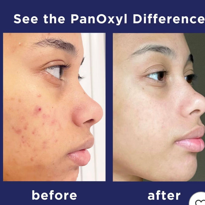 Traitement acné au benzoyle de peroxyde au Sénégal -- PanOxyl disponible chez American Elite West Africa